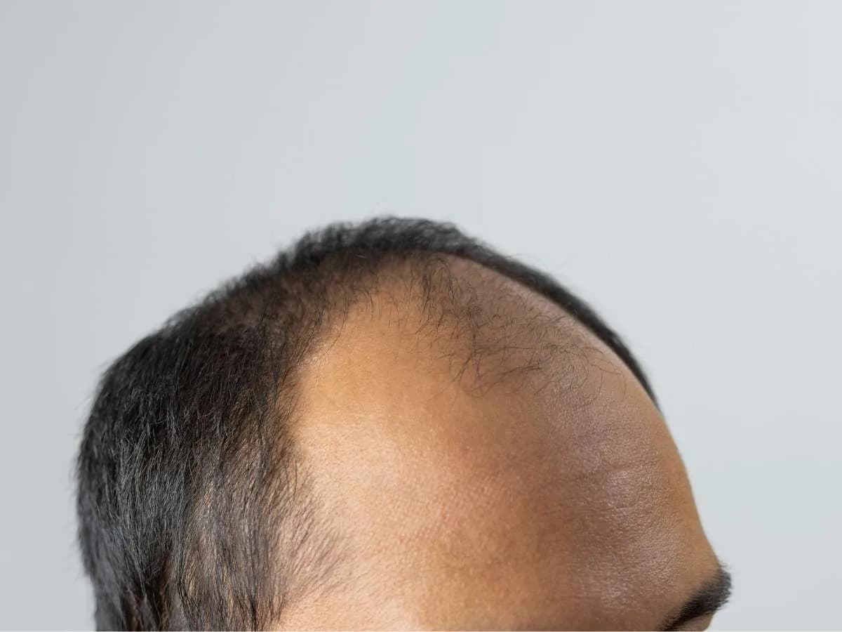 Early signs of male pattern baldness in a Filipino man. Learn how to prevent hair loss with expert tips at andyou.ph.